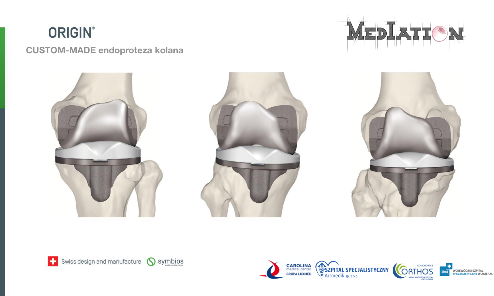 Personalizowane endoprotezy stawu biodrowego rewolucjonizują ortopedię. 
